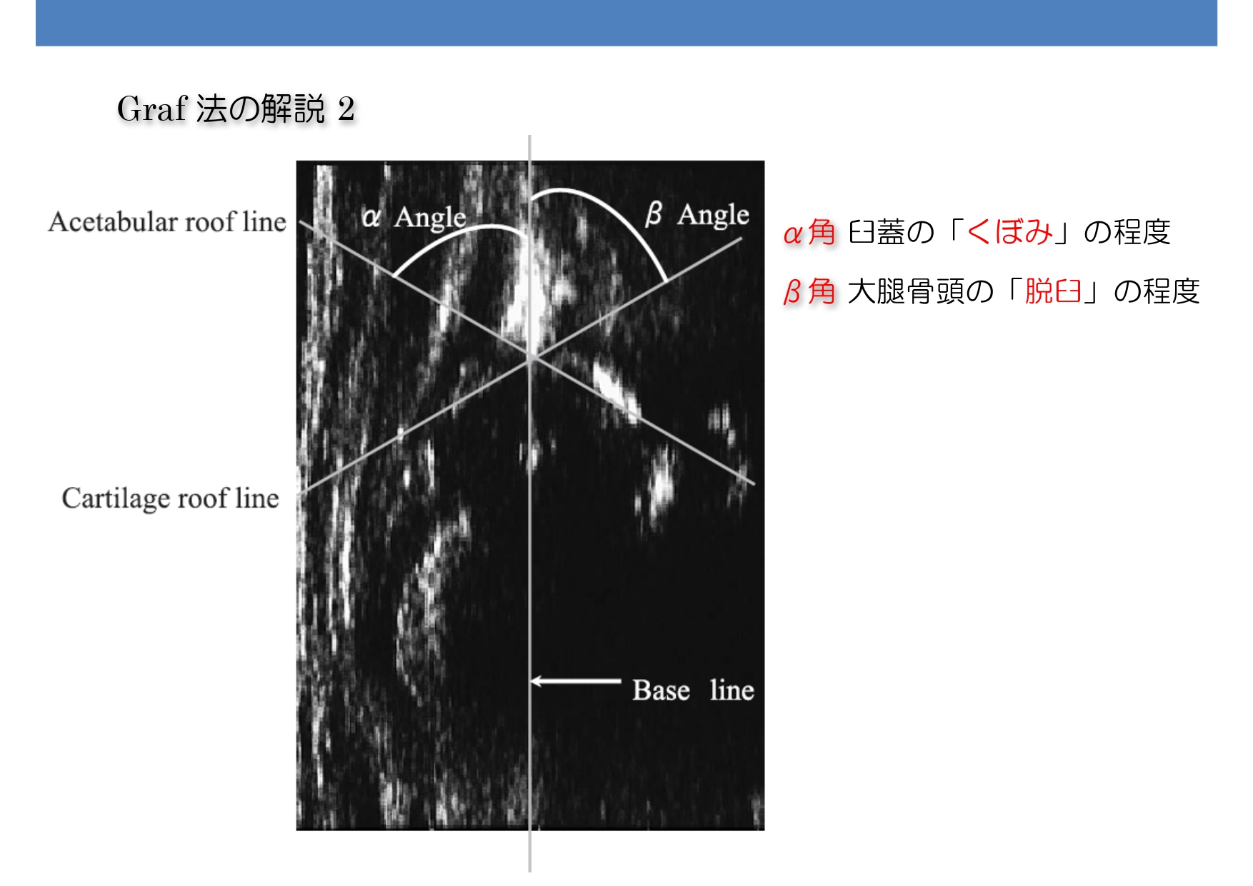Graf 法によらないエコーによる股関節脱臼の 実用的なスクリーニング法 ふかざわ小児科/小児科・アレルギー科・病児保育・予防接種|福岡市東区